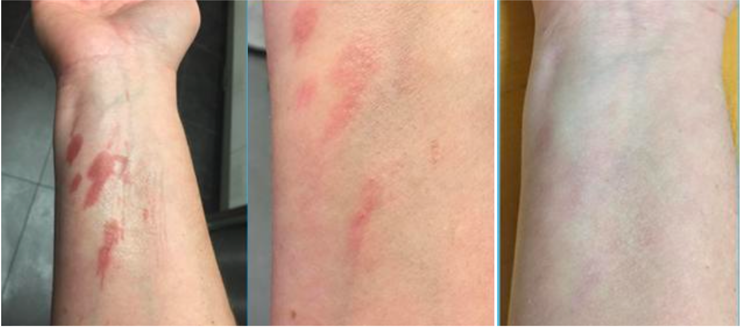 Burn wound before Abilar&reg; treatment and 20 days later